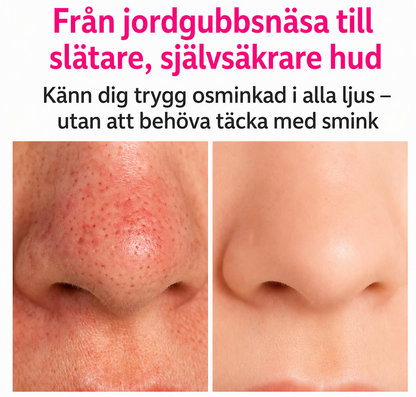 HealSkin® - Rena porer utan att klämma