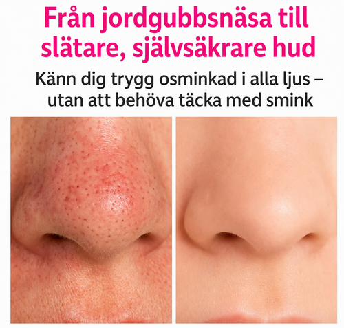 HealSkin® - Rena porer utan att klämma